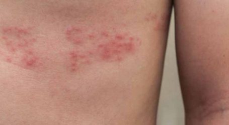 Aberta consulta pública para avaliar inclusão de vacina contra herpes zóster no SUS
