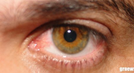 Dengue pode causar sintomas nos olhos como hemorragias e inflamação do nervo óptico