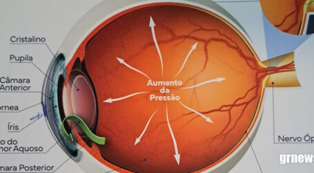Monitoramento do Glaucoma evitou cegueira em 300 mil brasileiros