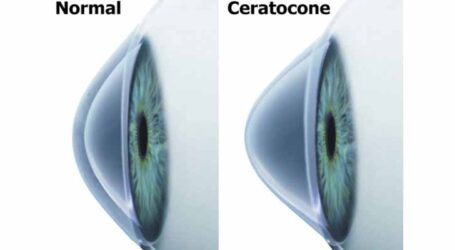 GRNEWS TV: Especialista alerta que diagnóstico precoce é essencial no combate ao Ceratocone