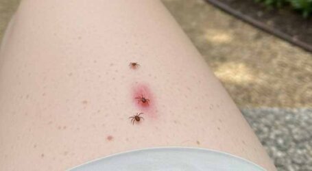 GRNEWS TV: Picada de qualquer carrapato deve acender alerta para febre maculosa