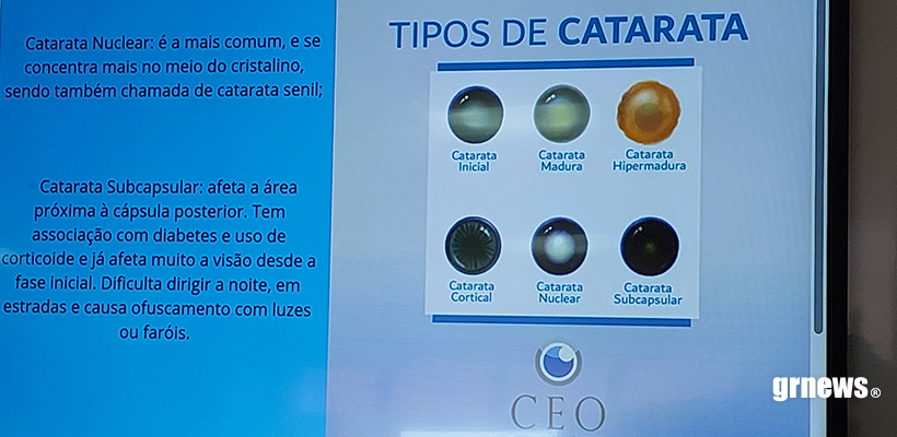 GRNEWS TV: Pacientes não precisam esperar a catarata “amadurecer” antes de realizar a cirurgia, alerta especialista
